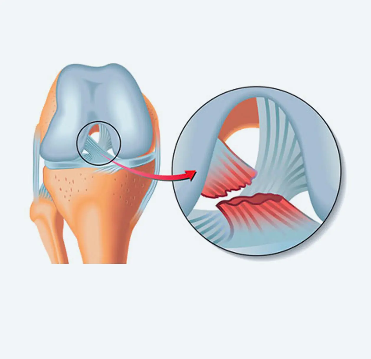Medical illustration showing torn ligaments in the knee joint