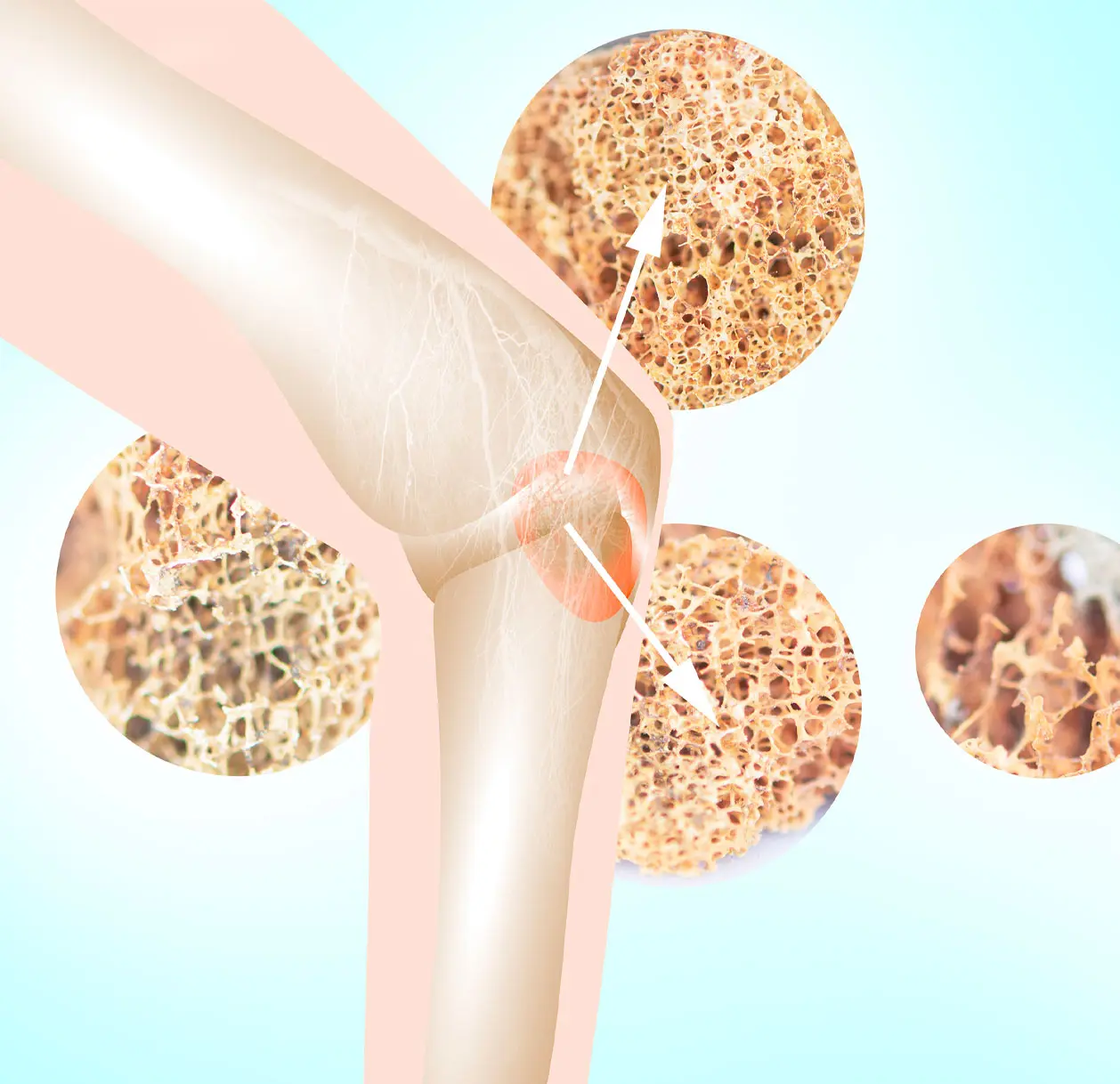 Bone Marrow Lesions (BMLs)