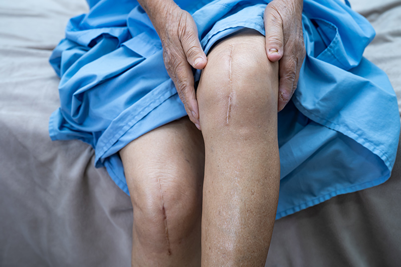 An elderly woman recovering from total knee replacement surgery